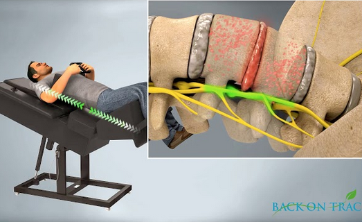 Spinal Decompression  Fort Worth, TX 